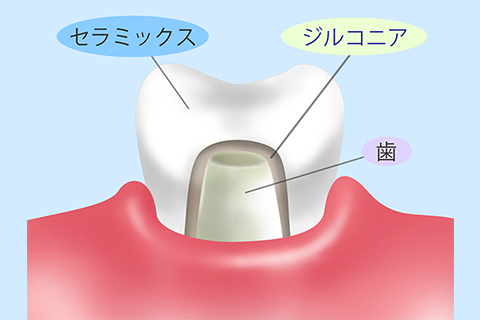 ジルコニアセラミック