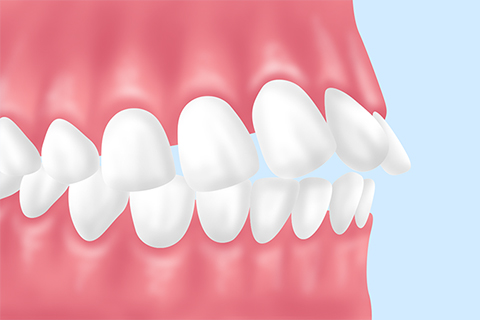 上顎前突（出っ歯）
