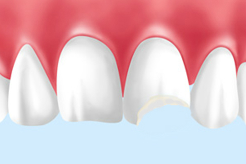 歯の破折や脱臼