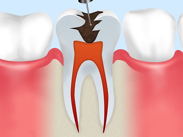 根管治療