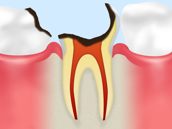 C4：歯根まで達した虫歯
