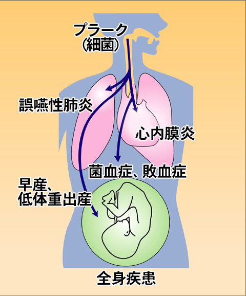 歯周病と全身疾患